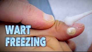 FREEZING WARTS With Sizzling Liquid Nitrogen  Dr Paul [upl. by Anirok]