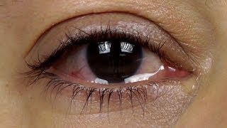 How To Get Rid Of Dry Eyes  4 Advanced Home Treatments [upl. by Ciapas]