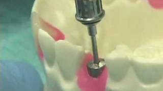 Placing Implant Abutments [upl. by Ailic]