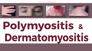 A Simplified Overview of Polymyositis amp Dermatomyositis  Clinical Features Diagnosis amp Treatment [upl. by Autry]