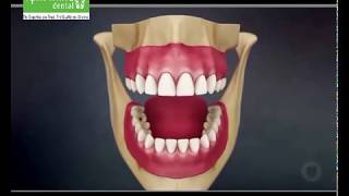 Root Canal Treatment Procedure  Apollo White Dental [upl. by Kooima273]