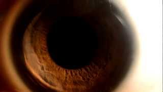 Watch an eye dilate [upl. by Mona]