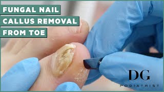 Fungal Nail Treatment And Callus Removal  The Foot Scraper DG Podiatrist [upl. by Gninnahc]