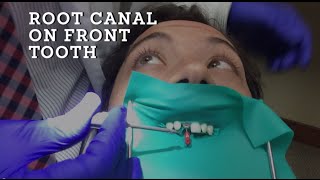 Root Canal Treatment Demonstration A how to procedure on Front Tooth in HD [upl. by Pence]