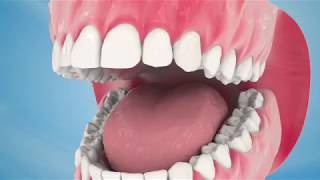 Dental Implant Procedure [upl. by Reinke]