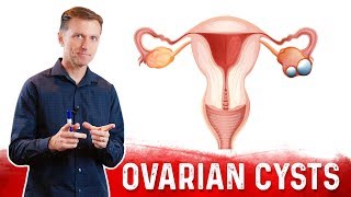 Ovarian Cysts Causes Symptoms amp Natural Treatment – DrBerg [upl. by Aitercul]