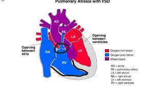 Pulmonary Atresia [upl. by Aihsaei742]