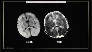 Pediatric Head Ultrasounds [upl. by Kieryt674]