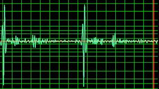 Aortic Regurgitation Ejection Systolic Murmur normal speed [upl. by Eilyk666]