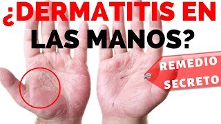 👋 Como curar la dermatitis en las manos  Remedio Secreto REVELADO [upl. by Opiuuk573]