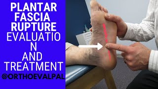 Callus removal from feet both feet and three verruca plantar warts treatment [upl. by Atoiganap]