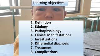 Nephrotic Syndrome  Pediatrics [upl. by Rudolfo]