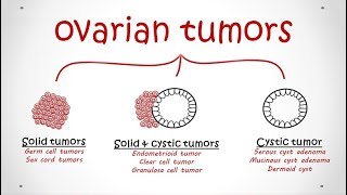 Ovarian Cancer Current and Novel Treatment Strategies [upl. by Lavery]