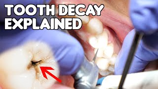 Tooth Decay Cavity Explained  Cavities vs Fillings vs Dental Caries [upl. by Violeta131]