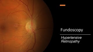 Hypertensive Retinopathy Fundoscopy [upl. by Etennaej953]