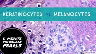 Melanocytes vs Keratinocytes Made Easy 5Minute Pathology Pearls [upl. by Htbazile807]