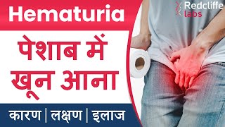 ⛔Hematuria पेशाब में खून आना  Symptoms And Causes in Hindi  ✅ Hematuria Blood in Urine का इलाज [upl. by Ailliw]