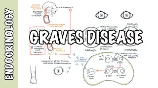 Graves Disease  Overview causes pathophysiology investigations and treatment [upl. by Gautier]