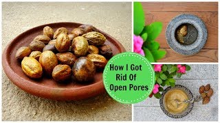 How I Got Rid Of Large OPEN PORES Permanently amp Naturally Using an Ayurvedic Remedy [upl. by Neersan]