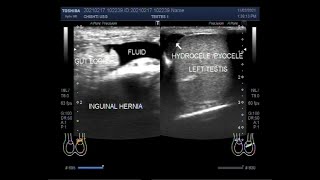 Hydrocele vs Varicocele vs Torsion vs Epididymitis vs Tumor [upl. by Enilrahc31]