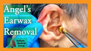 Angels Earwax Removal  Auburn Medical Group [upl. by Anolahs]