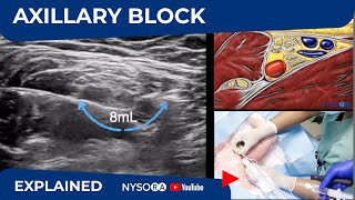 Ultrasound Guided Axillary Brachial Plexus Block NYSORA Regional Anesthesia [upl. by Eva]