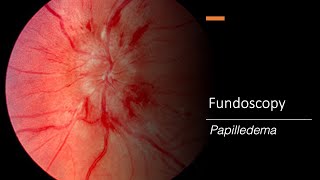 Papilledema Fundoscopy [upl. by Eelrak640]