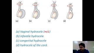 Ultrasound video Hydrocele and epididymal cyst [upl. by Sokairyk817]