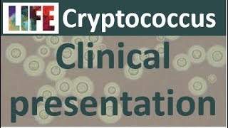 Cryptococcosis clinical presentation [upl. by Maitland]