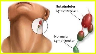 Entzündung der Lymphknoten [upl. by Crowley]