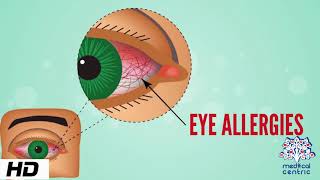 How to stop watery eyes  Dr Sunita Rana Agarwal [upl. by Nemaj]