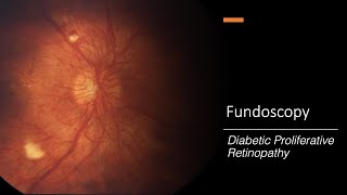 Diabetic Proliferative Retinopathy Fundoscopy [upl. by Eronaele]