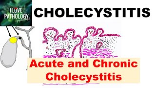 CHOLECYSTITIS Acute and Chronic Pathology and Complications [upl. by Magdau718]