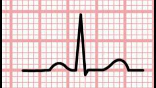 ECG Interpretation  Time and the ECG Section 1 Part 5 [upl. by Lilias]