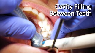 Dentist Filling A Cavity Between Teeth [upl. by Bergerac]