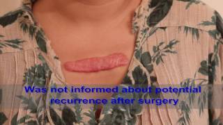 Chest Keloids  Mistakes to Avoid [upl. by Grunenwald]