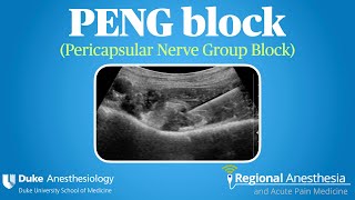 PENG Block Pericapsular Nerve Group Block [upl. by Haikan]