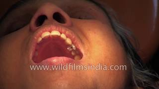 Root Canal treatment in India [upl. by Epul]