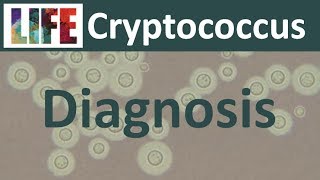 Diagnosing cryptococcal meningitis [upl. by Ydnyc]