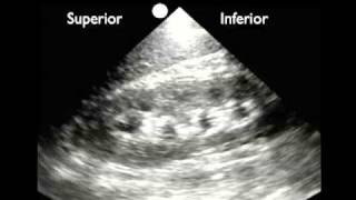 Testicular Hydrocele pyocele varicocele and Inguinal Hernia [upl. by Laughry908]