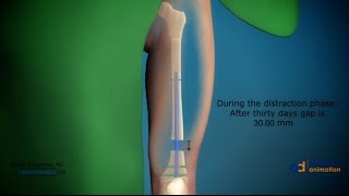 Cosmetic Leg Lengthening Surgery Postop 10 years [upl. by Elleinod]