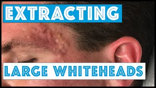 Acne Vulgaris and Extracting large Whiteheads  Part 1 [upl. by Hedi]