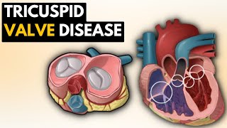 Pulmonary Atresia and Ventricular Septal Defect and Truncus Arteriosus Lan Nguyen MD [upl. by Anigriv]