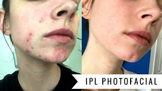 IPL PHOTOFACIAL  Before amp After FOUR WEEKS [upl. by Regdirb]