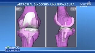 Artrosi al ginocchio una nuova cura [upl. by Garnet]