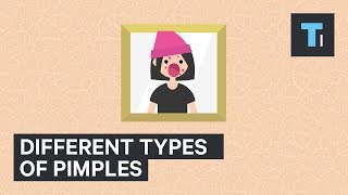 Different Types Of Pimples And How To Treat Them [upl. by Ahcila961]