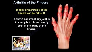 Arthritis Of The Fingers  Everything You Need To Know  Dr Nabil Ebraheim [upl. by Shelburne]