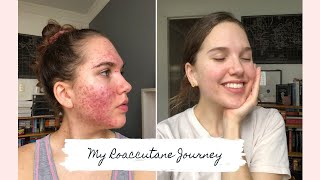 Roaccutane  My 6 Month Journey to Clear Skin [upl. by Akemehs]