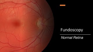 Healthy Retina Fundoscopy [upl. by Gwenn]