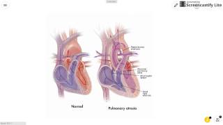 Pulmonary Atresia [upl. by Donetta]